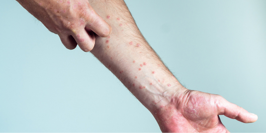 pikkelysömör jelei tünetei